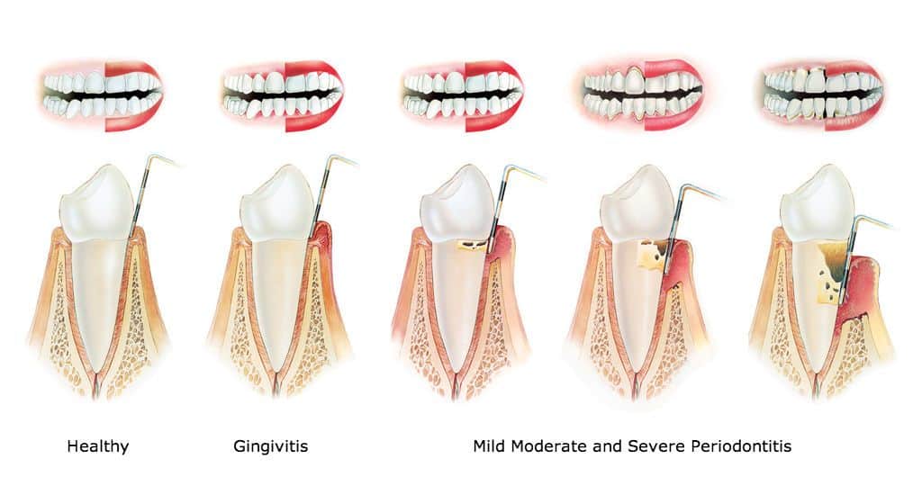 Flossing Tips Using Your Ecofloss -Biodegradable, Sustainable, Ecofriendly