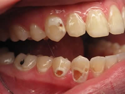 soft drink decay in teeth