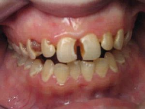 tooth erosion